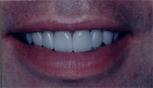 porcelain veneers Toronto