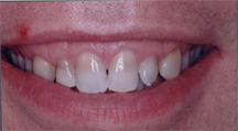 porcelain veneers Toronto